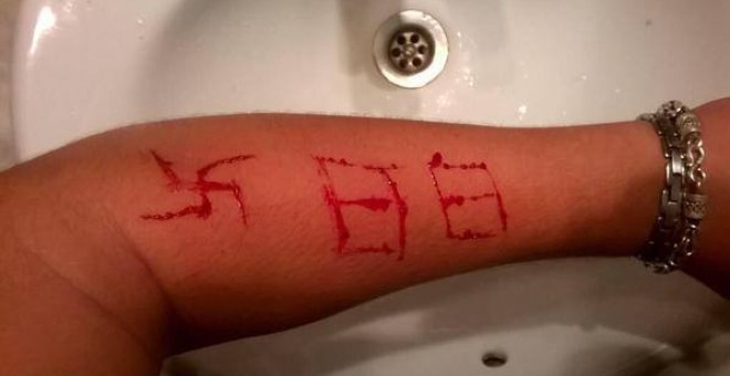 Imagen del brazo del menor tras la agresión por parte de miembros un grupo de extrema derecha.