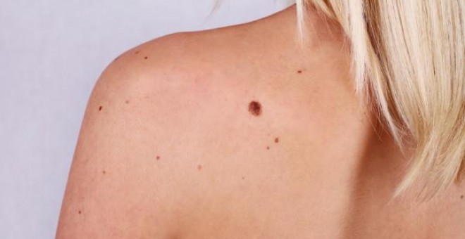 El melanoma es el cáncer de piel menos común pero el que mayor tasa de mortalidad tiene.