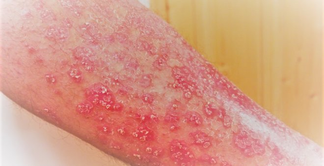 La psoriasis es una enfermedad inflamatoria cutánea de carácter autoinmune que provoca el desprendimiento e infección de la piel causando dolor e hinchazón