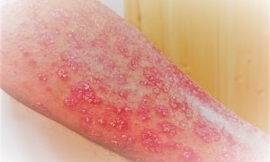 La psoriasis es una enfermedad inflamatoria cutánea de carácter autoinmune que provoca el desprendimiento e infección de la piel causando dolor e hinchazón