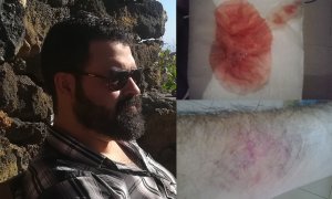 Imagen combinada cedidas por Ruymman Rodríguez de los hematomas que tenía y sangre que escupía al salir del cuartelillo.