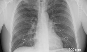 Radiografía de unos pulmones