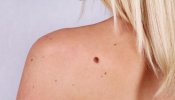 El melanoma es el cáncer de piel menos común pero el que mayor tasa de mortalidad tiene