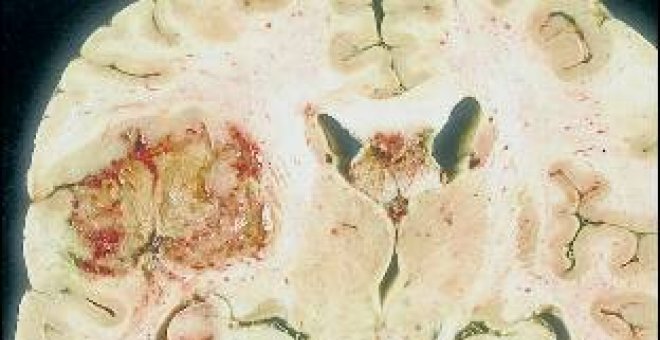 Cinco nuevas alteraciones genéticas del glioblastoma