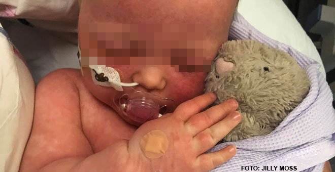 Las desgarradoras fotos de un bebé con sarampión, la mejor arma contra los antivacunas