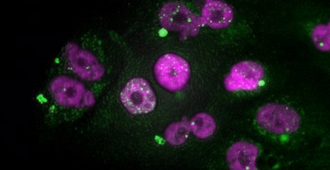 Una vacuna experimental de ARN muestra resultados prometedores en el cáncer de páncreas