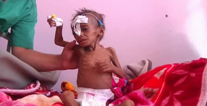 Yemen se expone a una brutal crisis humanitaria por hambre