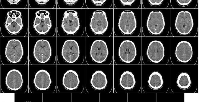 Un grupo de investigadores identifica 75 regiones del genoma asociadas al alzhéimer