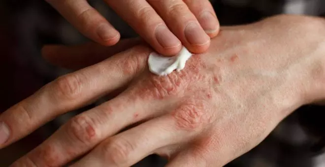 Los pacientes con psoriasis grave tienen mayor riesgo cardiovascular