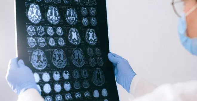 Un estudi d'investigadors catalans avala la detecció precoç de l'Alzheimer amb una anàlisi de sang