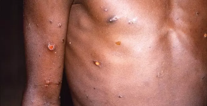 África declara la emergencia de salud pública por el brote de mpox